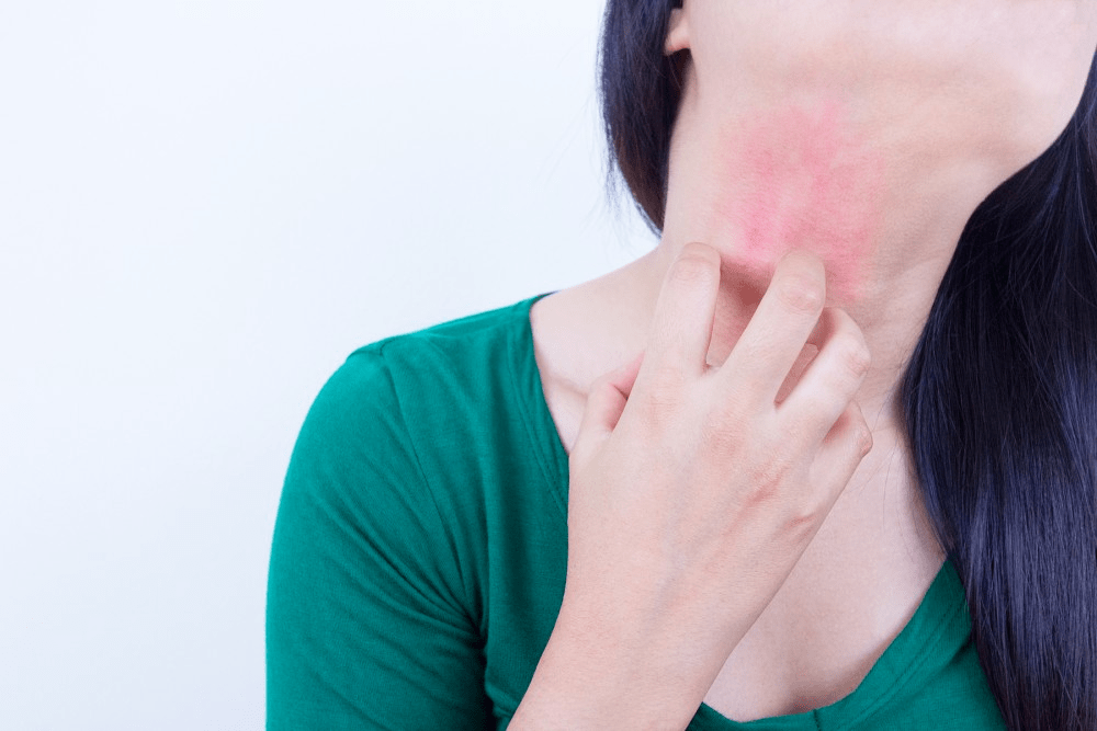 woman scratching her itchy and red neck