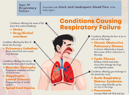 Conditions Causing Respiratory Failure