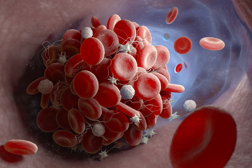 blood clot inside a blood vessel