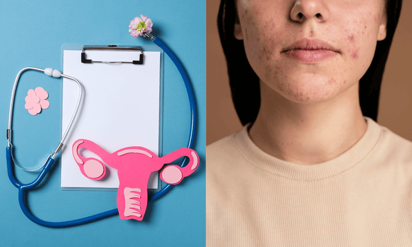 A Guide To Living With PCOS thumbnail