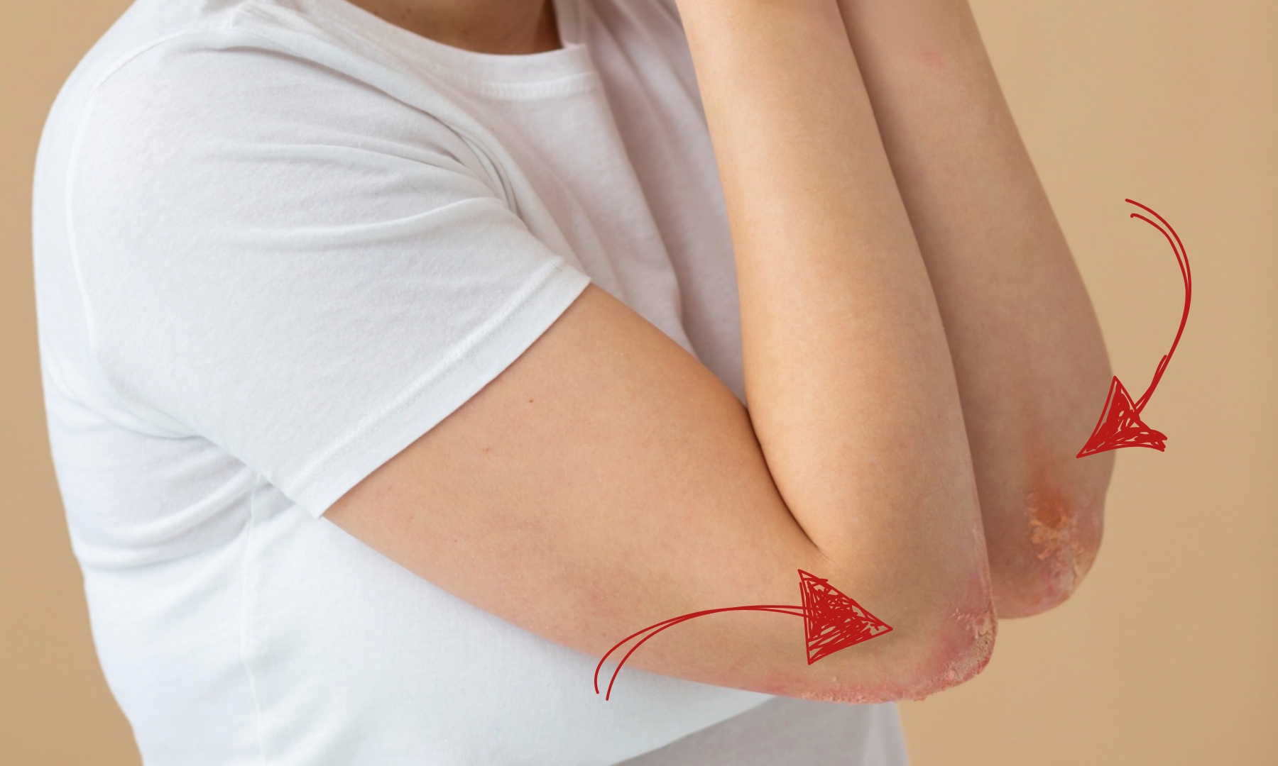 person with red, scaly patches on both elbows due to psoriasis