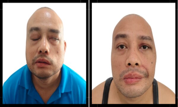 Makati Medical Center Achieves Milestone With First-Ever Facial Reanimation Surgery
