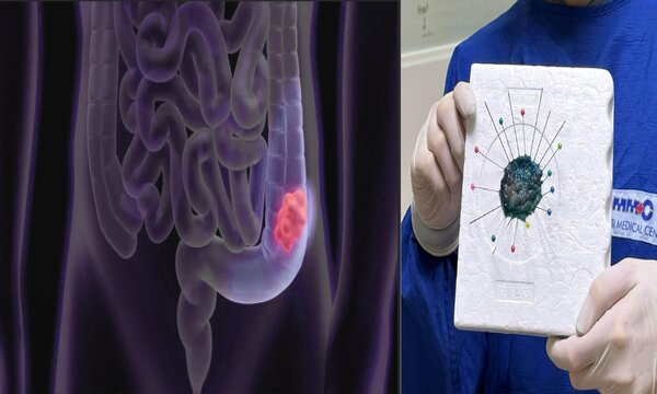 Endoscopic Submucosal Dissection (ESD)